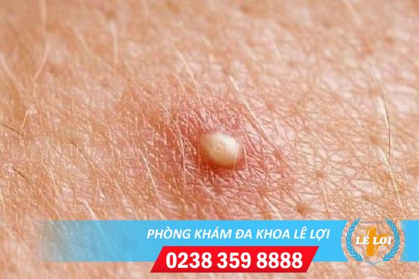 Nổi mụn mủ cậu nhỏ là bệnh gì nguy hiểm không?