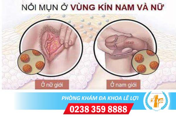 Vì sao vùng kín nổi mụn trắng?