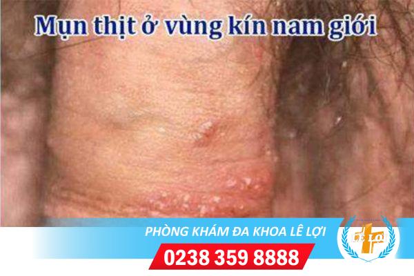 Mụn thịt dương vật có nguy hiểm không?