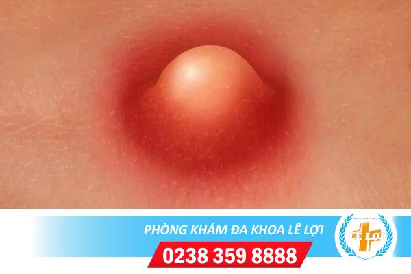 Mụn nhọt âm đạo có nguy hiểm không?