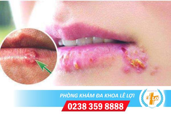 Nguyên nhân nổi mụn nước ở môi và cách điều trị