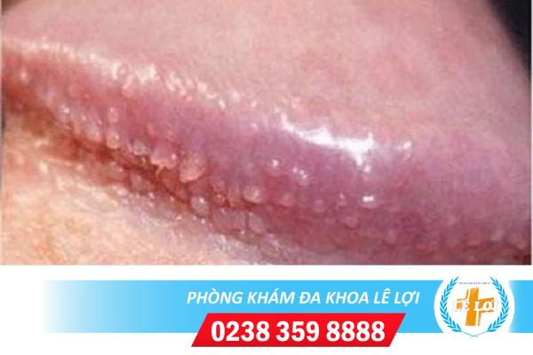 Thận trọng khi gặp tình trạng mụn nước quy đầu