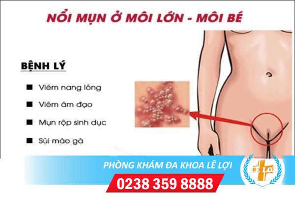 Mọc nhọt ở môi lớn, môi bé là do đâu?