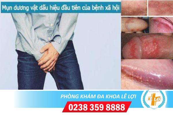 Mụn trắng quy đầu là dấu hiệu của bệnh xã hội