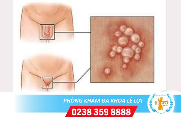 Dấu hiệu điển hình của mụn nước sinh dục