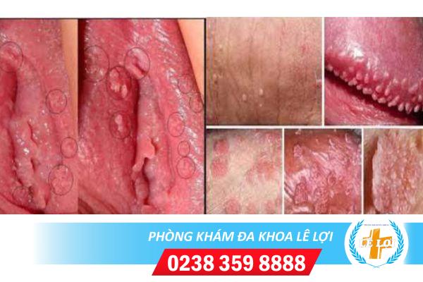 Mụn thịt sinh dục và những nguyên nhân phổ biến