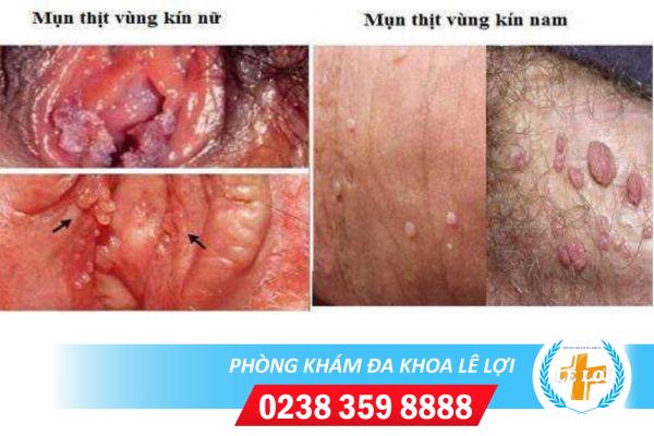 Mụn thịt vùng kín là dấu hiệu bệnh sùi mào gà?