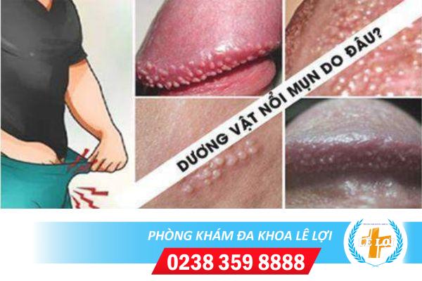 Nổi mụn trắng cậu nhỏ là bị bệnh gì?