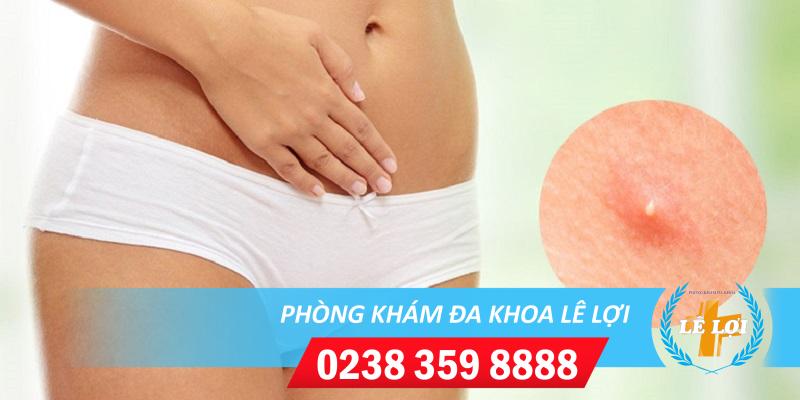 Cảnh giác với hiện tượng nổi mụn vùng kín