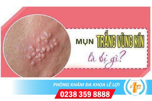 Nổi mụn trắng ở vùng kín là bị bệnh gì?