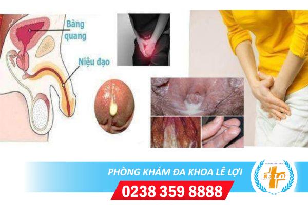 Niệu đạo chảy mủ có phải là bị bệnh lậu?