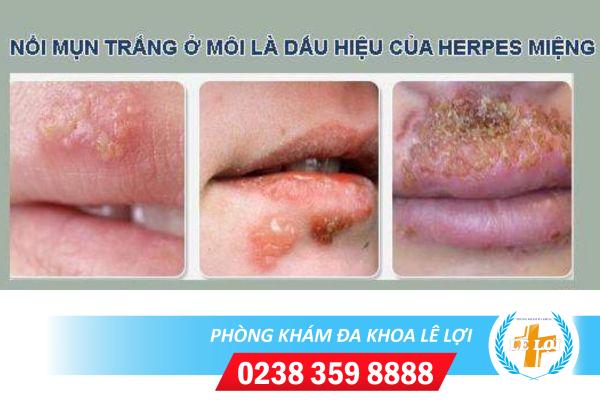 Nguyên nhân nổi mụn trắng ở môi và cách điều trị