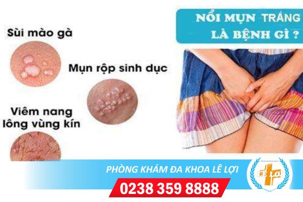 Những điều cần biết về hiện tượng nổi mụn trắng ở nữ