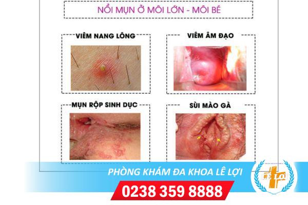Mụn nước ở môi bé + môi lớn là bị bệnh gì?