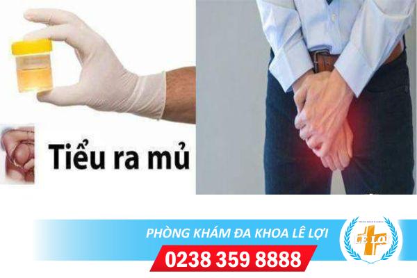 Tiểu có mủ là bị bệnh gì nguy hiểm không?