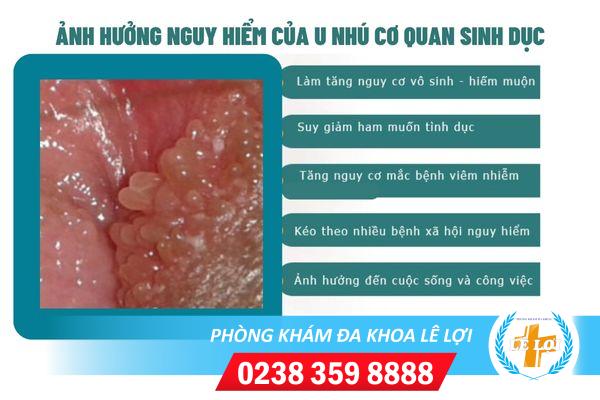 u-nhu-co-quan-sinh-duc