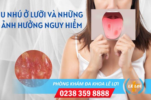 U nhú ở lưỡi có nguy hiểm không?