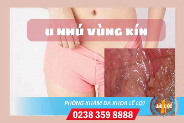 Cảnh giác khi bị u nhú vùng kín