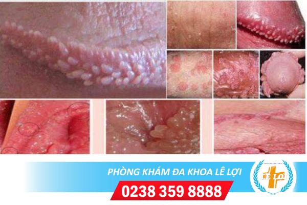 Thịt dư vùng kín và những điều cần biết
