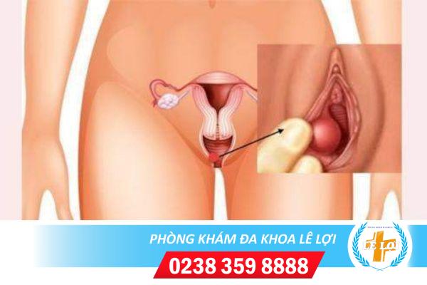 Dấu hiệu nhận biết viêm tuyến bartholin và cách chữa trị