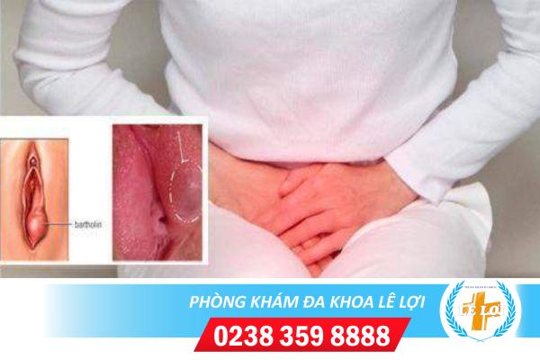 Thuốc trị viêm tuyến bartholin nào hiệu quả?