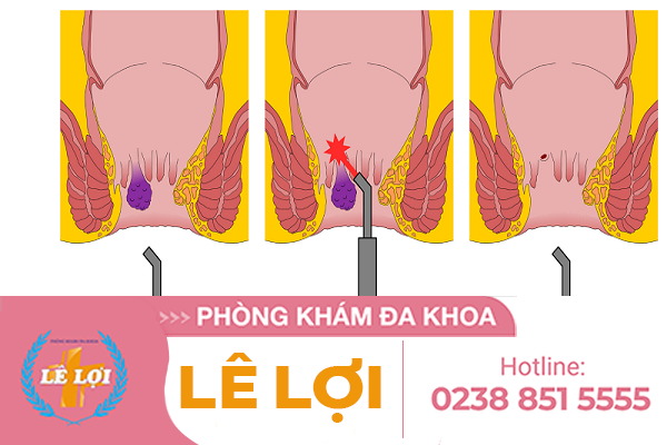 Cắt trĩ bằng laser và những điều cần biết