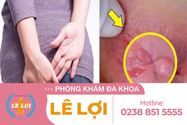 Triệu Chứng Bệnh Trĩ Ở Người Bệnh Dễ Nhận Biết