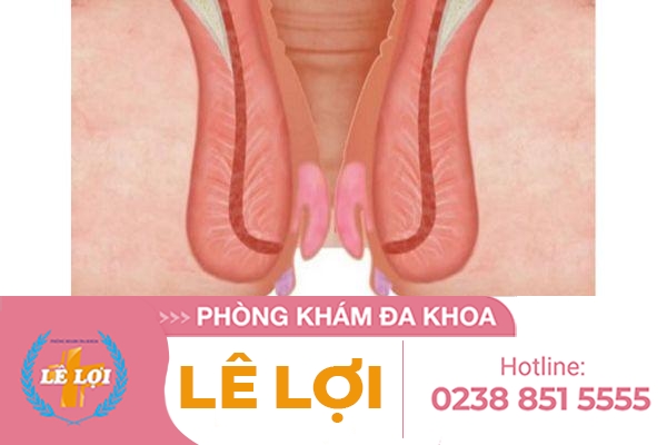 Ngứa búi trĩ phải làm sao?