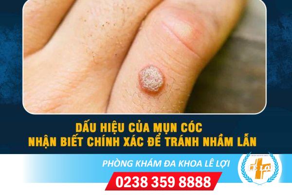 Đốt mụn cóc hiệu quả không?