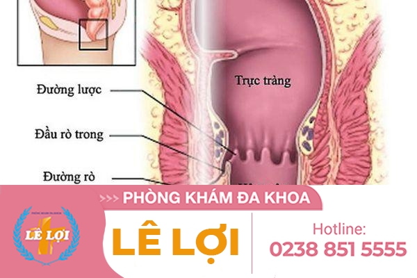 Bệnh viện hậu môn trực tràng tại Vinh – Nghệ An