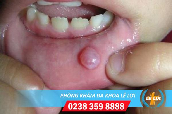Mụn nước ở môi là bị bệnh gì nguy hiểm không?
