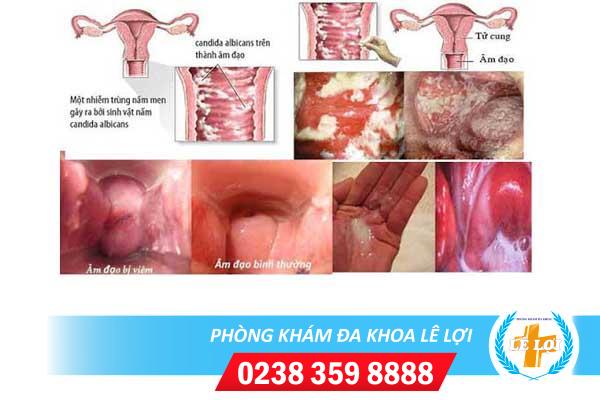 Phương pháp điều trị nấm candida ở nữ giới
