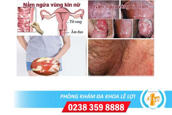 Cách điều trị nấm ngứa vùng kín hiệu quả