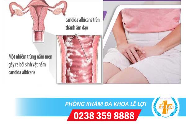 Chữa trị nấm phụ khoa an toàn và hiệu quả