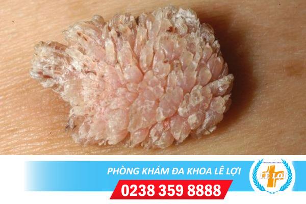 Nấm mào gà là bệnh gì? nguy hiểm không?