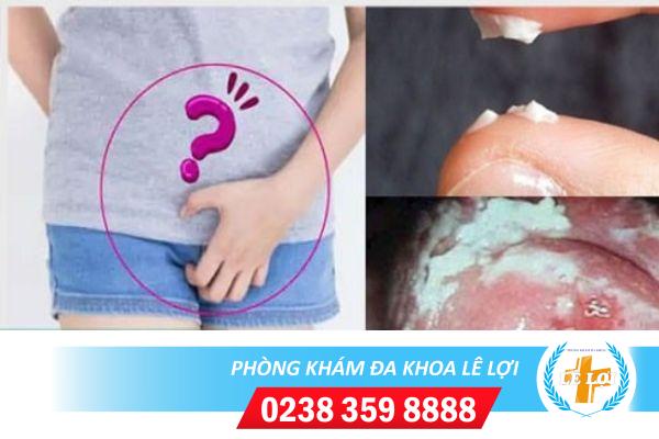 Nấm trắng ở vùng kín là bị gì?