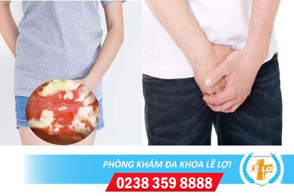 Chữa trị nấm vùng kín ở đâu hiệu quả?