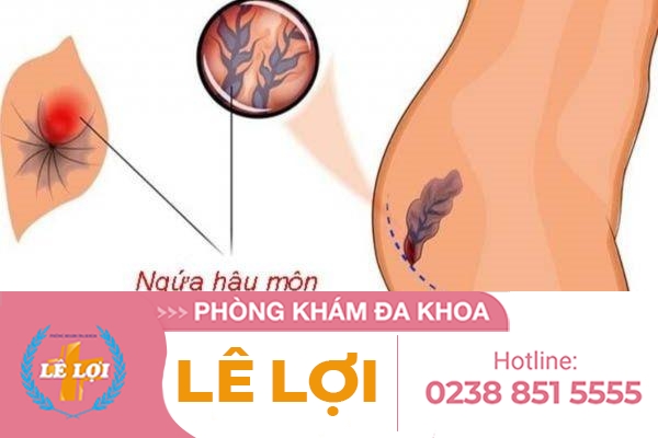 Sưng ngứa vùng hậu môn là bệnh gì?