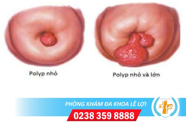 Các bệnh lý cổ tử cung thường gặp và cách điều trị