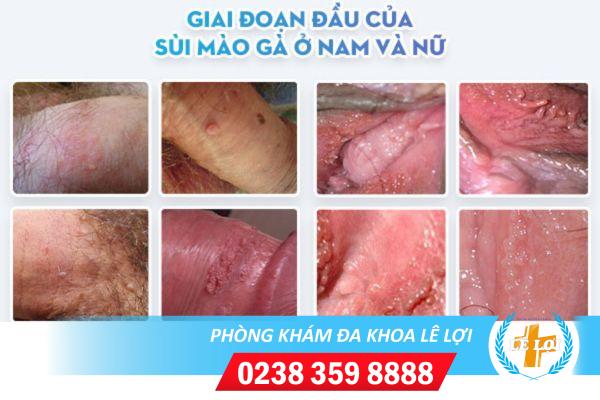Triệu chứng sùi mào gà giai đoạn cuối