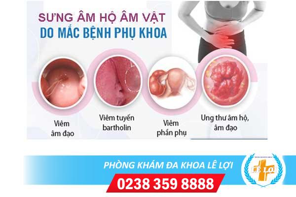 Sưng âm hộ âm vật phải làm sao?