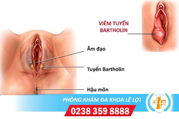 Sưng âm hộ âm vật là bị bệnh gì?