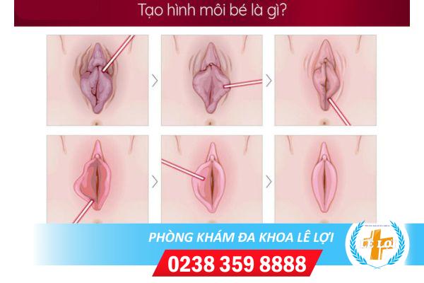 Tạo hình chỉnh hình môi bé vùng kín bao nhiêu tiền?