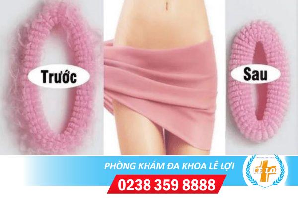 Thu nhỏ môi bé môi lớn ở đâu tại Vinh Nghệ An?