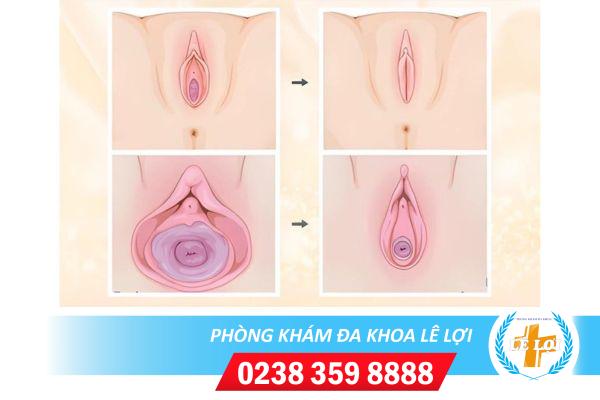 Thẩm mỹ âm đạo vùng kín ở đâu tại Vinh Nghệ An?