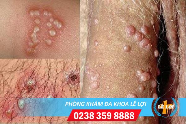 Dấu hiệu mụn cóc dương vật và cách điều trị