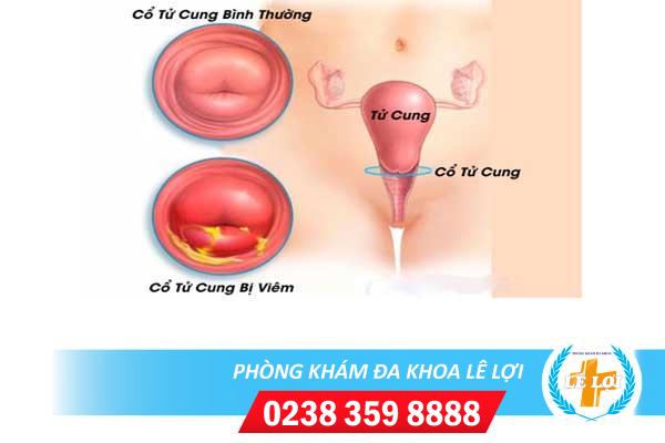 Dấu hiệu viêm cổ tử cung nặng và nhẹ