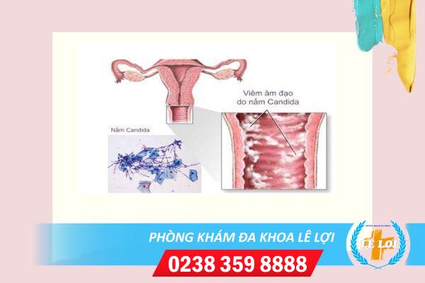 Viêm nhiễm âm đạo nguy hiểm không?