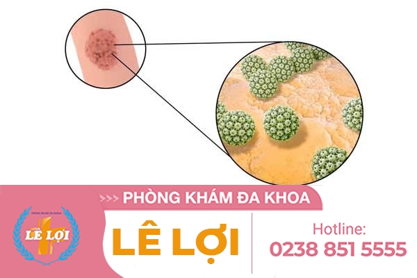 benh-condyloma-dau-hieu