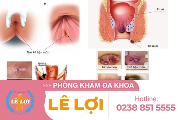 Bệnh viện hậu môn trực tràng nào tốt ở Vinh?